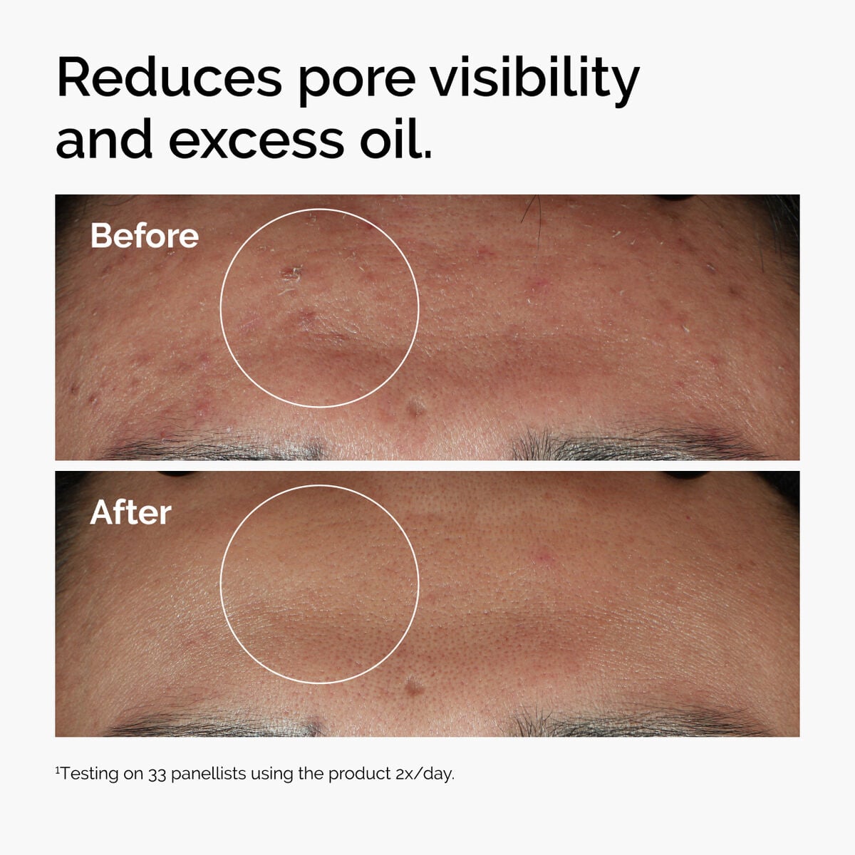 niacinamide-10-zinc-1-o8 ord-niacinamide-zinc-blemish-serum-before-after-pores.jpg