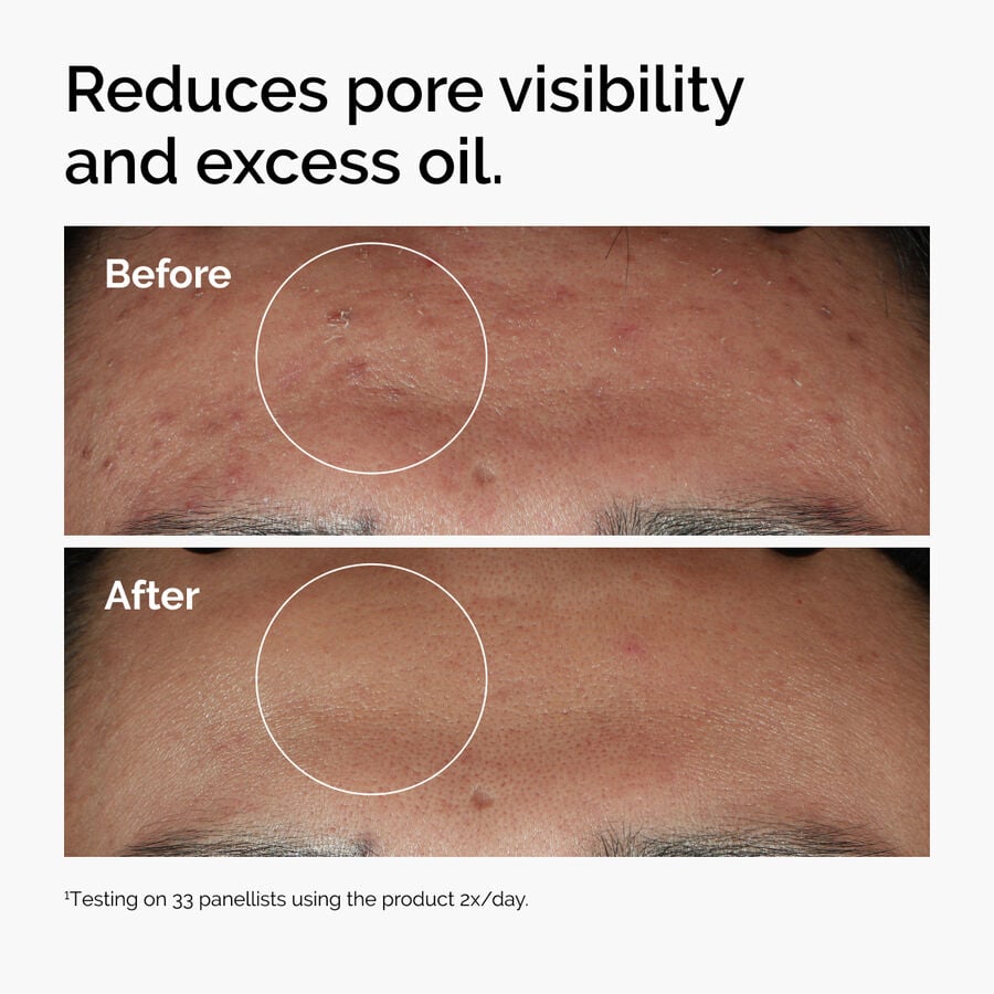 niacinamide-10-zinc-1-o8 ord-niacinamide-zinc-blemish-serum-before-after-pores.jpg