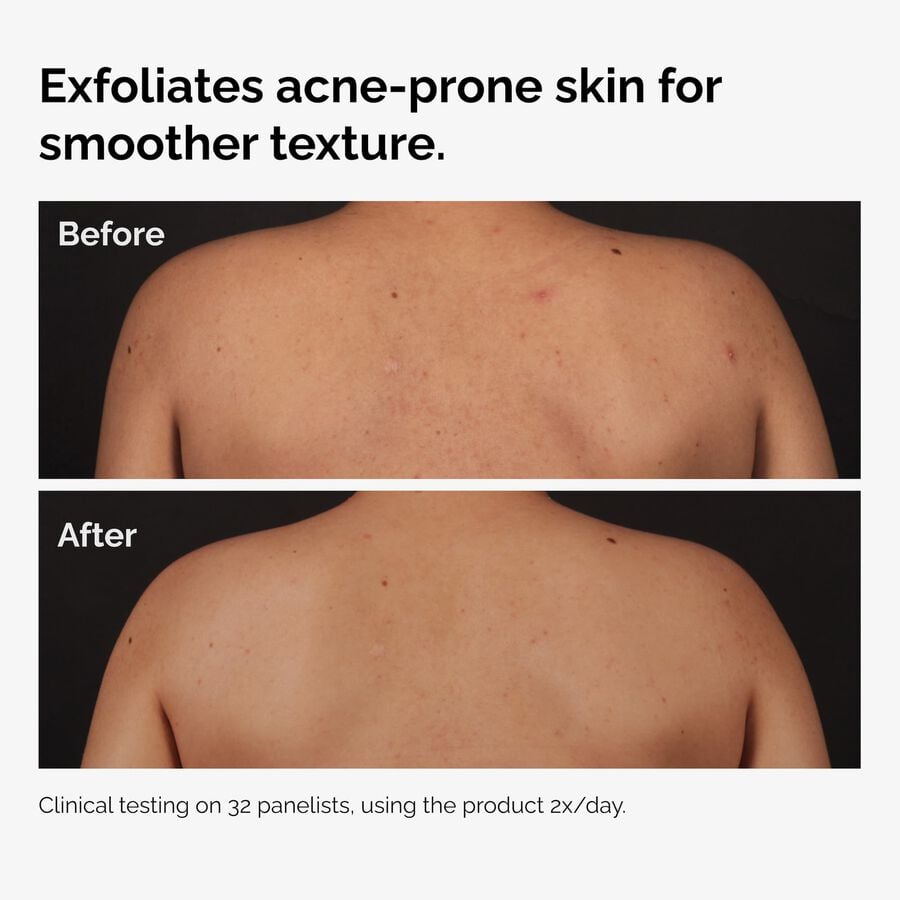 the-body-care-collection-o2 ord-salicylic-acid-body-serum-before-after-graphic-NA.jpg