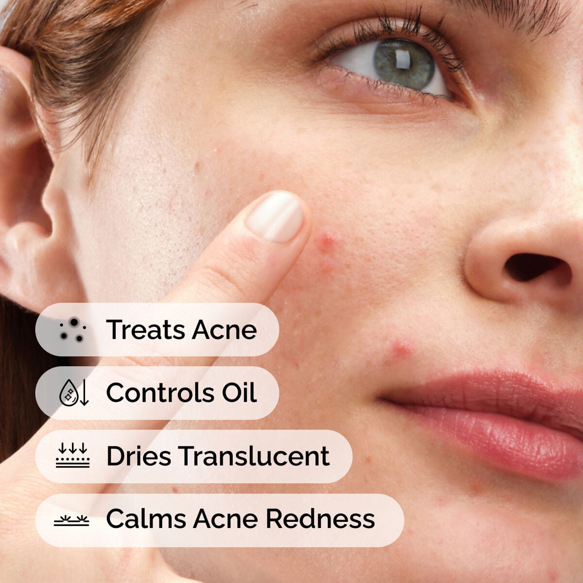 sulfur-10-powder-to-cream-concentrate-f2 ord-sulfur-10pct-powder-to-cream-concentrate-model-application-with-benefits-acne.jpg