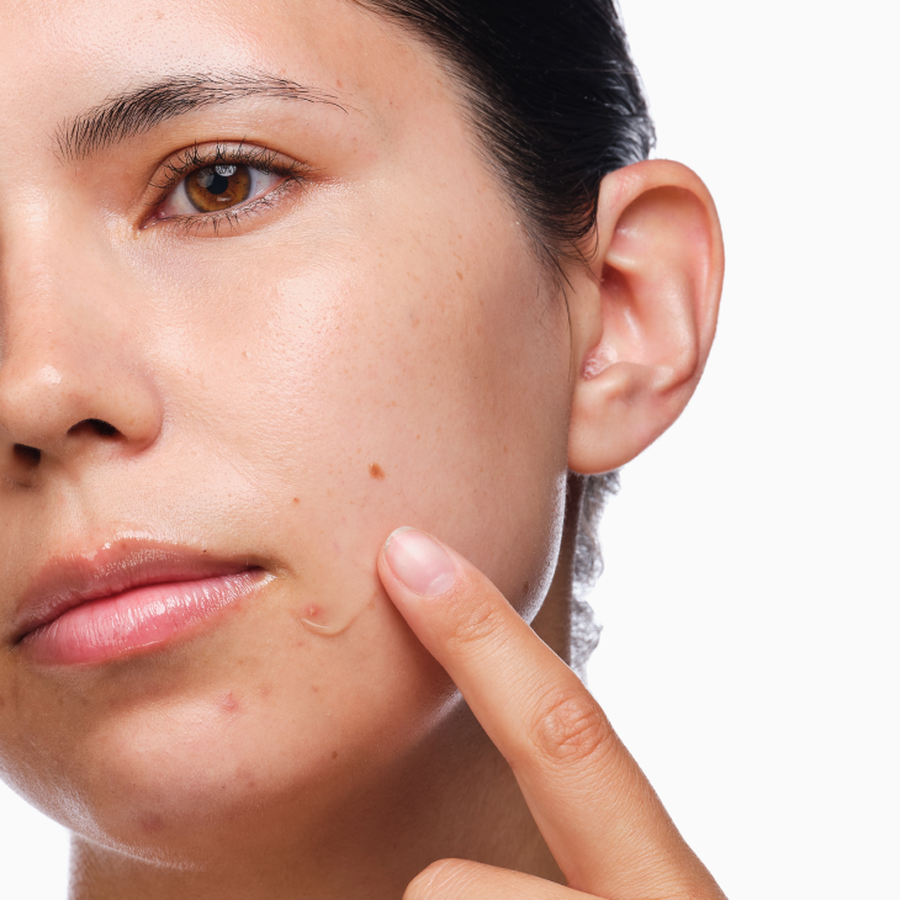 the-acne-set-d8 rdn-the-acne-set-application.png